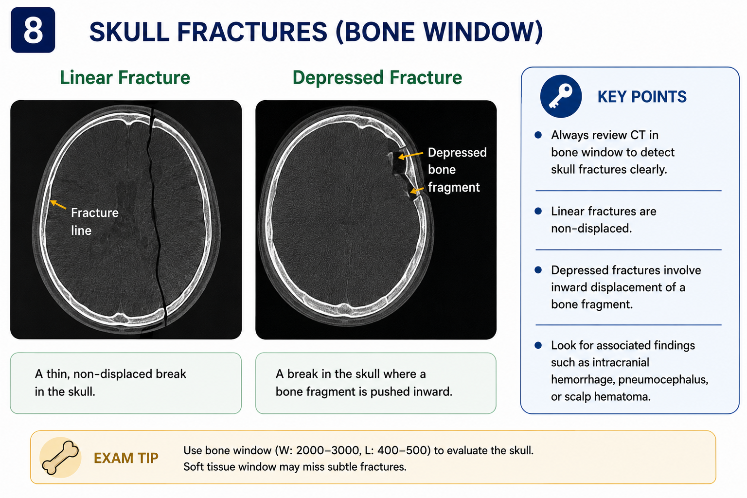 Types of skull fractures on CT bone window